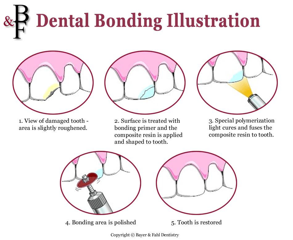 Dental Bonding Illustration
