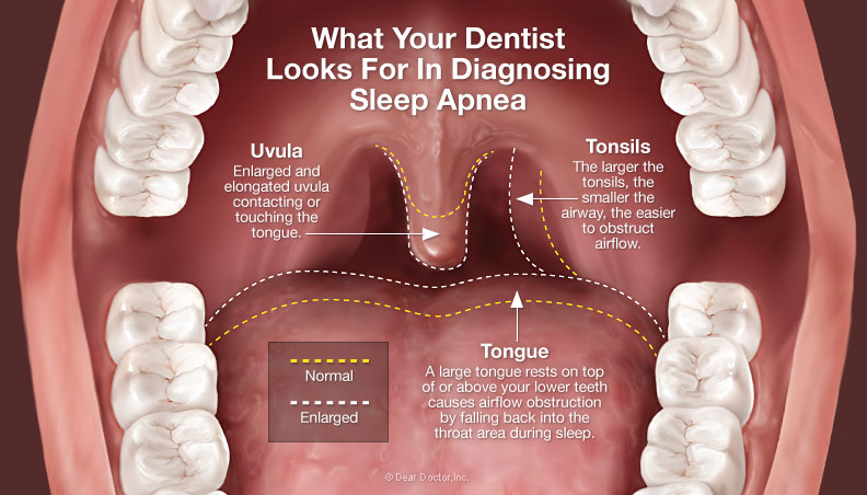 Diagnosing Sleep Apnea